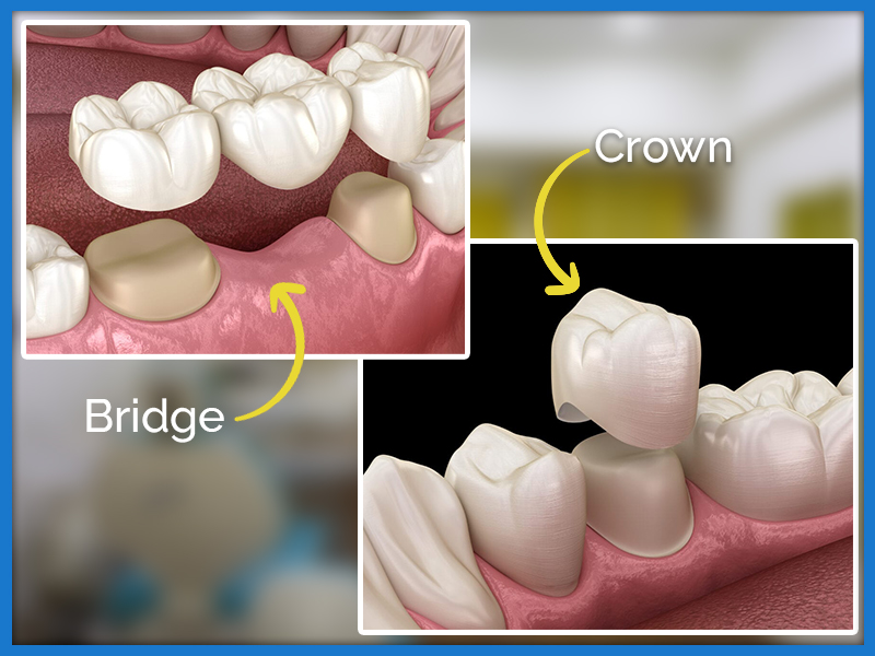 Metal Free Crowns & Bridges