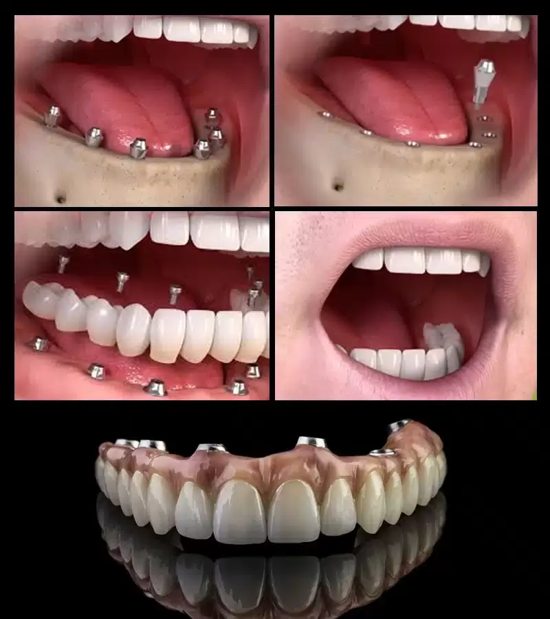 Dental Implants Procedure