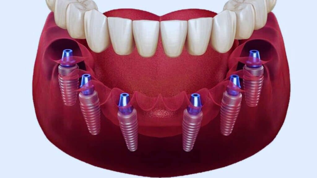 Metal Free Implant Treatment