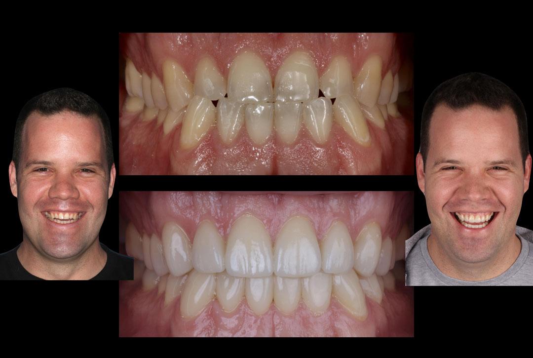 Full Mouth Rehabilitation