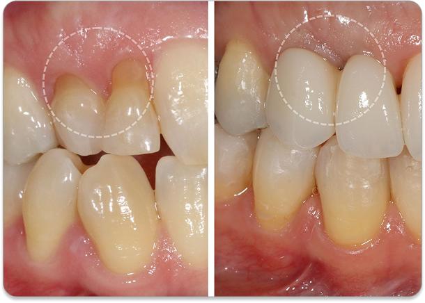 Bone Grafting & Gum Surgeries