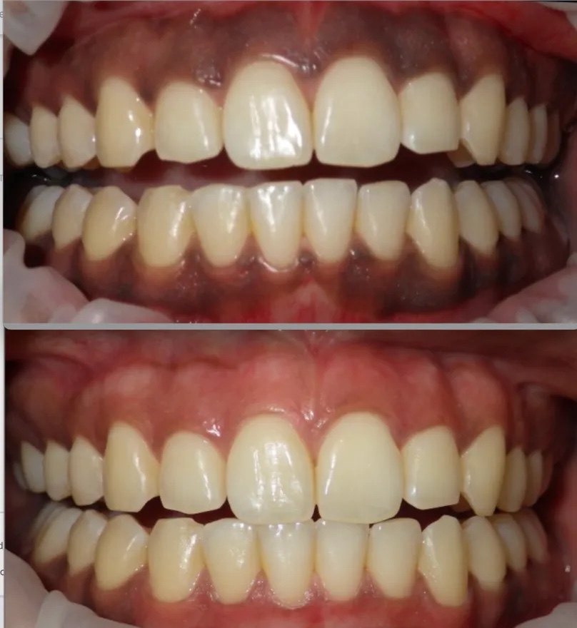 Periodontal Treatment