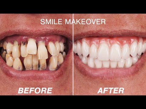 Smile Makeover